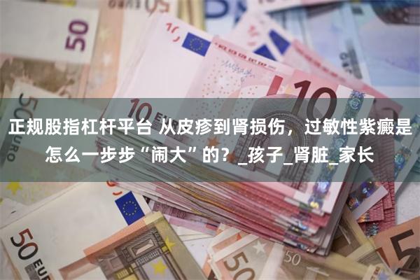 正规股指杠杆平台 从皮疹到肾损伤，过敏性紫癜是怎么一步步“闹大”的？_孩子_肾脏_家长